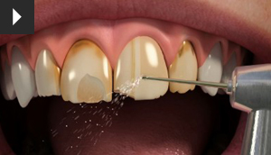 Porcelain Veneers