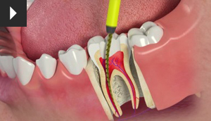 Root Canal Treatment